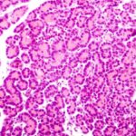 ¿Qué causa la diabetes mellitus tipo 1