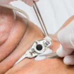 ¿Cuáles son las causas principales de fístula traqueal?