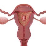 ¿Cómo se diagnostica la neoplasia trofoblástica maligna?