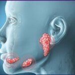 Tumores de las glándulas salivales