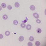 ¿Qué causa el paludismo?