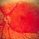 ¿Cuáles son las etapas clínicas de la retinopatía diabética?
