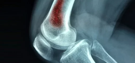 ¿Cuáles son las causas infecciosas de la osteomielitis?