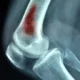 ¿Cuáles son las causas infecciosas de la osteomielitis?