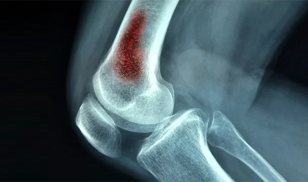 ¿Cuáles son las causas infecciosas de la osteomielitis?