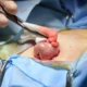 Indicaciones para la formación de una colostomía