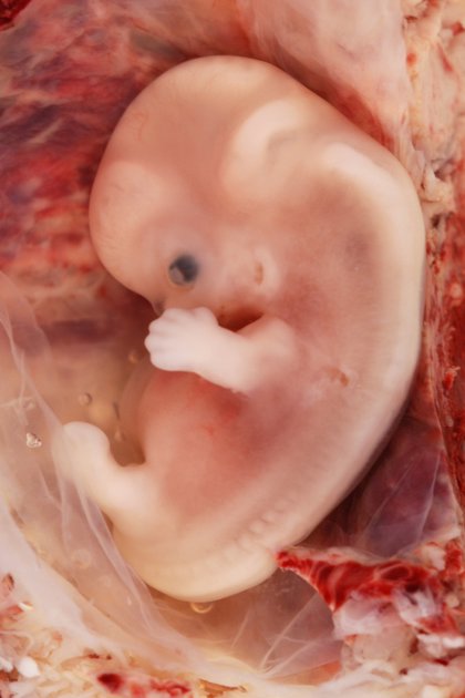 ¿Qué es el Injerto de tejido fetal?