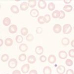 ¿Cómo se manifiesta clínicamente la anemia megaloblástica?