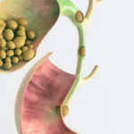 ¿Qué características tienen los cálculos biliares de pigmento?