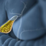 Factores de riesgo para padecer enfermedad por cálculos biliares