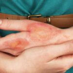 ¿Cómo puede tratarse el dolor en pacientes quemados?