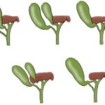 Variantes anatómicas de la vesícula y vías biliares