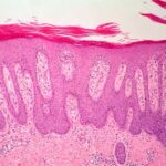 ¿Cuáles son las características histológicas de la psoriasis?