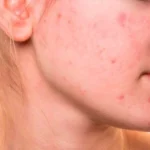 ¿Cuál es la causa del acné?