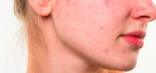 ¿Cuál es la causa del acné?