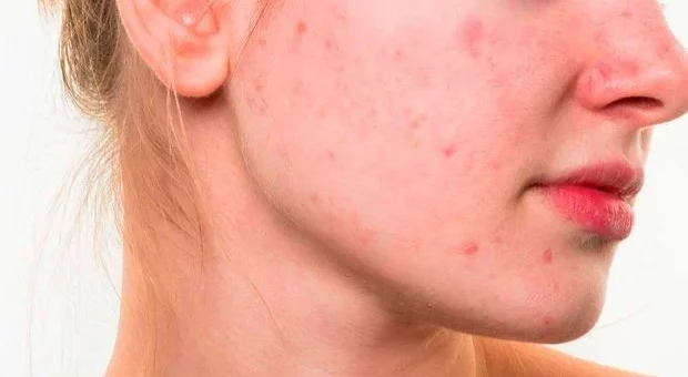 ¿Cuál es la causa del acné?