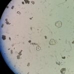 ¿Qué es la cistinuria?