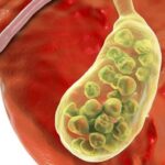 ¿Por qué se forman cálculos en la vesícula biliar?