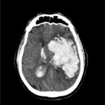 ¿Qué es la hemorragia intracerebral?