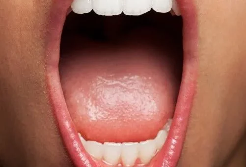 ¿Cuáles son las infecciones frecuentes de la cavidad oral?