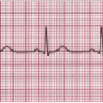 ¿Cuáles son las causas de taquicardia y bradicardia con ritmo sinusal?