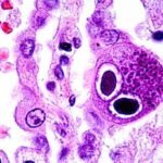 ¿Qué causa la infección por citomegalovirus?