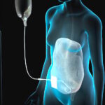 ¿Cuál es la complicación más frecuente de la diálisis peritoneal?