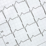 ¿Qué es la electrocardiografía?