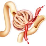 ¿Qué es la glomerulonefritis?