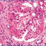 glomeruloesclerosis segmentaría focal
