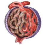 ¿Cuáles son las causas comunes de glomerulonefritis posinfecciosa?