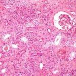 ¿Cuáles son las causas de nefritis intersticial?