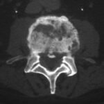 ¿Qué causa la osteomielitis vertebral?