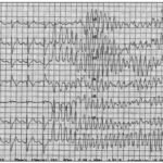 ¿Qué es una tormenta eléctrica o tormenta de taquicardia ventricular??