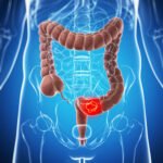 Factores de riesgo para cáncer de colon
