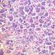 ¿Cuáles son los tipos de colangiocarcinoma por su forma de crecimiento?