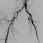 ¿Qué es la enfermedad oclusiva de las arterias iliacas?