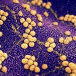 ¿Qué es la osteomielitis por Staphylococcus aureus?