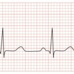 ¿Qué partes componen el trazo de un electrocardiograma normal?