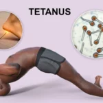 Toxina tetánica