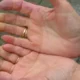 Fenómeno de Raynaud