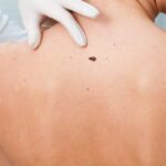¿Qué es el melanoma maligno?