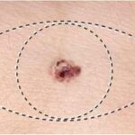 Tratamiento quirúrgico del melanoma