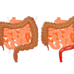 ¿Qué es la enfermedad de Hirschsprung?