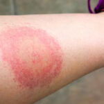 ¿Qué es la enfermedad de Lyme?