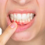 ¿Qué es un flemón dental?