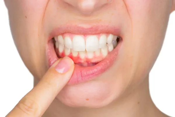 ¿Qué es un flemón dental?