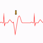 ¿Como se ven las extrasístoles ventriculares en el EKG?