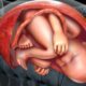 Corioamnionitis y metritis