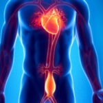 ¿Qué qué es un aneurisma aórtico?